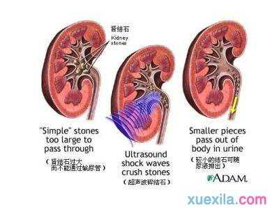 胆固醇结石怎么治疗