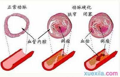 动脉硬化的症状