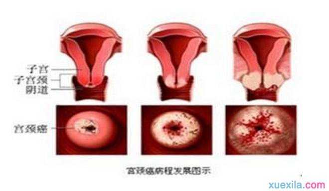 宫颈糜烂的症状及其成因