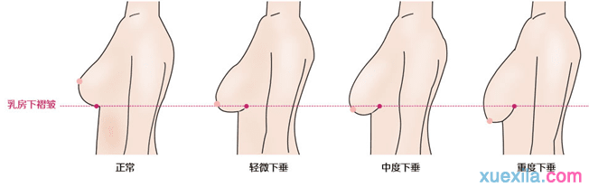 乳房下垂什么原因