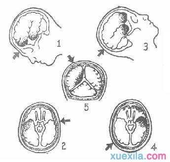 脑损伤治疗方法