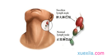 颈部淋巴结肿大吃什么药，治疗颈部淋巴结肿的药