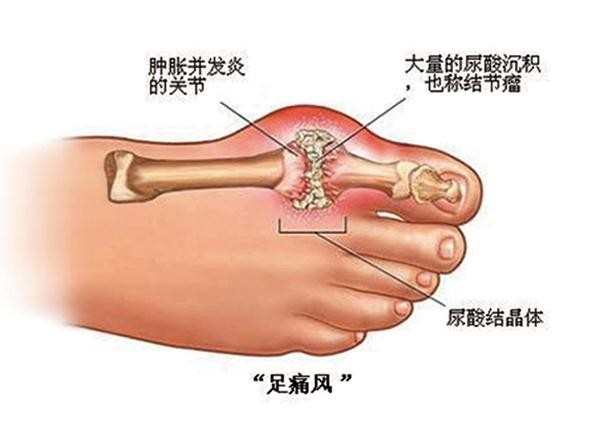 什么原因导致痛风频发