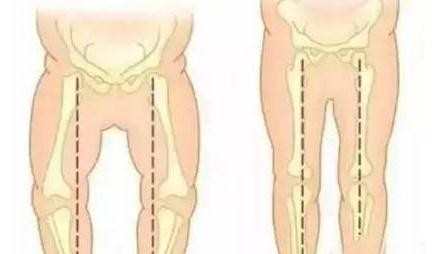 儿童罗圈腿怎么形成的
