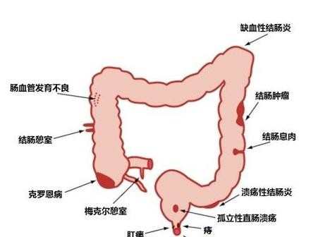 引起小儿消化道出血的原因