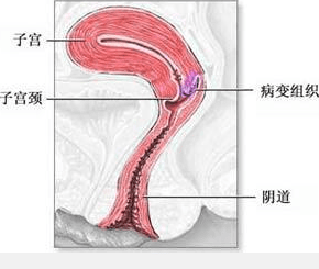 子宫癌是怎么形成的，子宫癌形成的原因