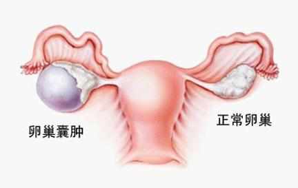 卵巢囊肿怎么形成的,卵巢囊肿的原因