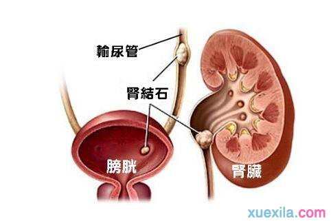 急性肾结石如何治疗 急性肾结石的治疗方法