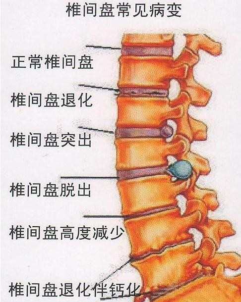 腰突是怎么形成的，腰突的原因