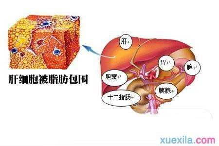 肝硬化的症状与引起原因