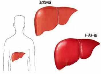 甲肝的症状 预防甲肝怎么做