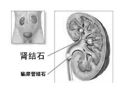 肾结石偏方 肾结石的民间偏方及食膳