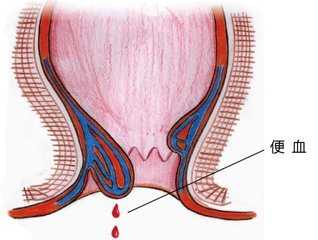 大便疼痛出血是什么原因