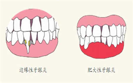 什么是边缘性龈炎